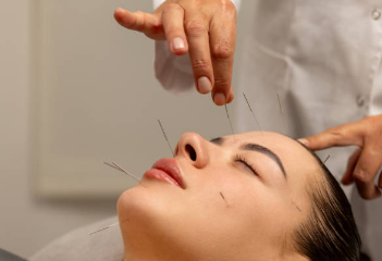 akupuktura
